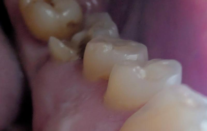ndg sascha burnham teeth
